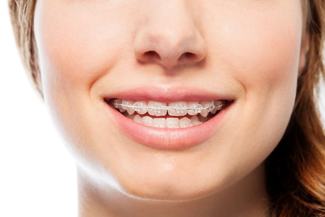 Appareil dentaire orthodontique : pour qui et comment l’entretenir ?