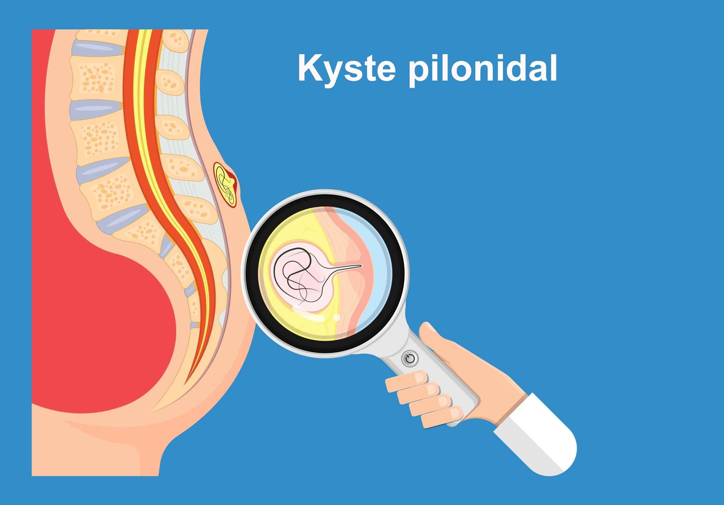 Kyste pilonidal : définition