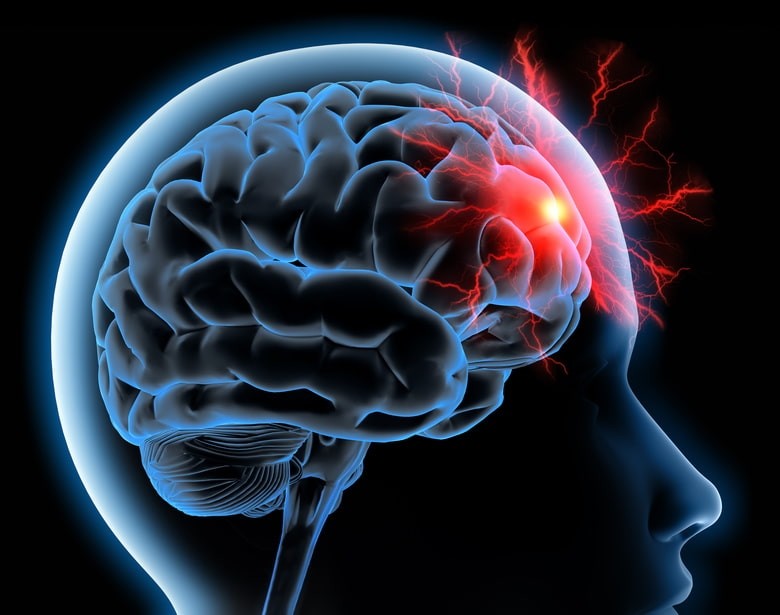 Accident vasculaire cérébral (AVC) : ce qu'il faut savoir