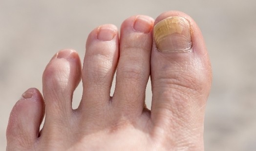 Comment soigner une mycose des ongles ?