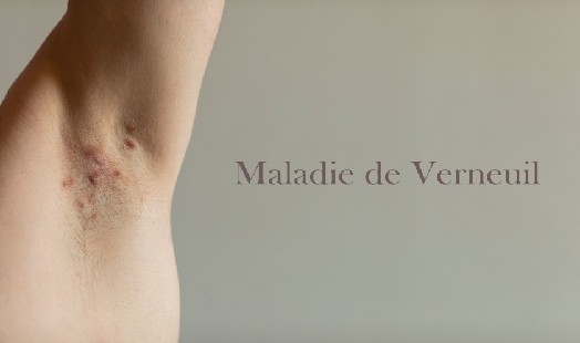 Maladie de Verneuil : causes et traitements