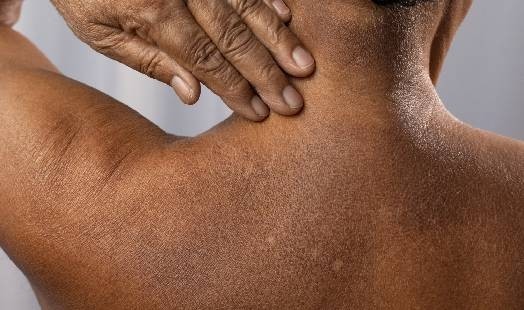 Pityriasis versicolor : symptômes, cause et traitement