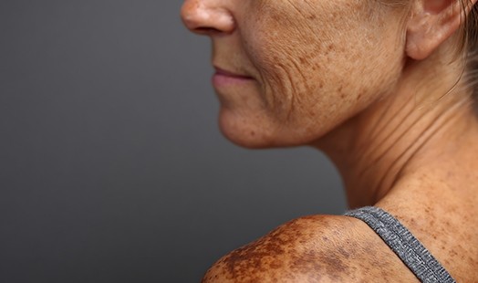 Taches brunes : comment les prévenir et les atténuer