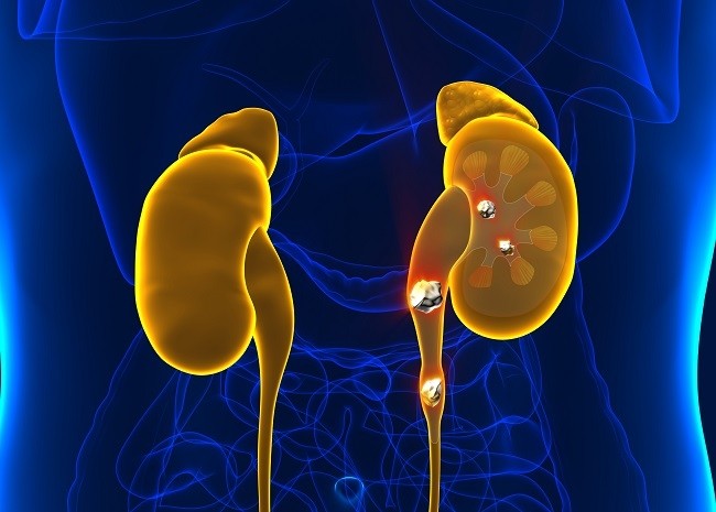 Tout savoir sur les calculs rénaux et la colique néphrétique