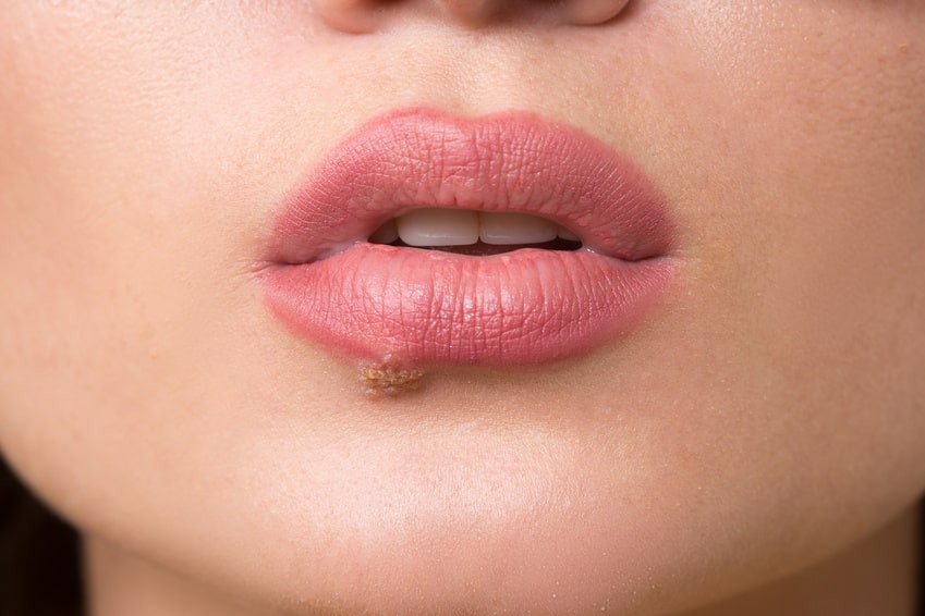 Herpès labial : comment soigner un bouton de fièvre ?