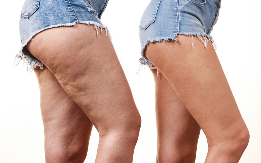 Comment enlever la cellulite ?