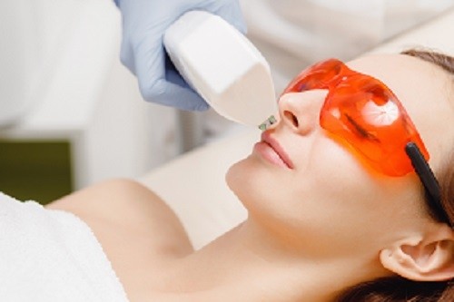 Hyperpilosité de la femme : comment enlever poils et duvet du visage ?