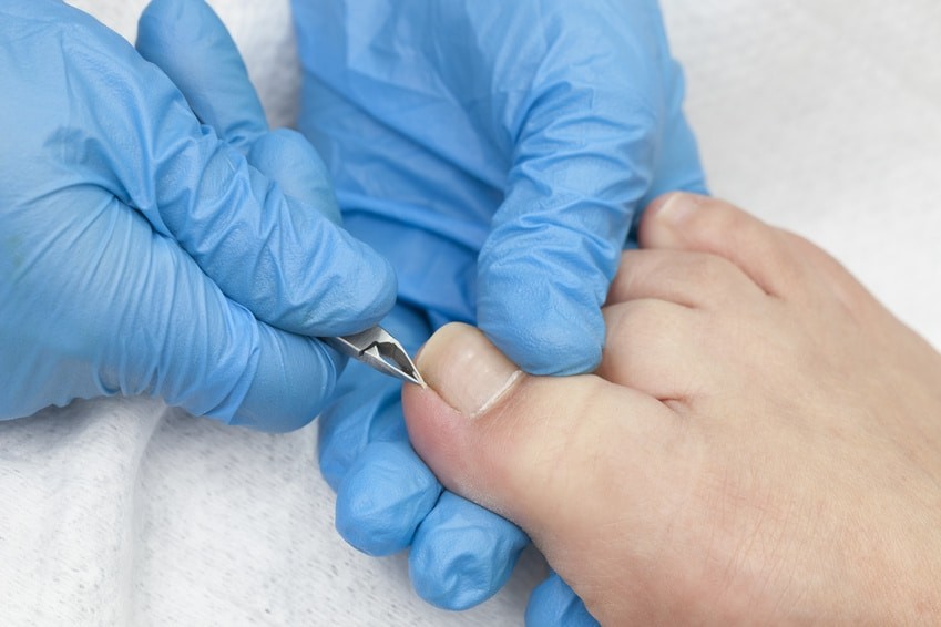 Ongle incarné : que faire ?