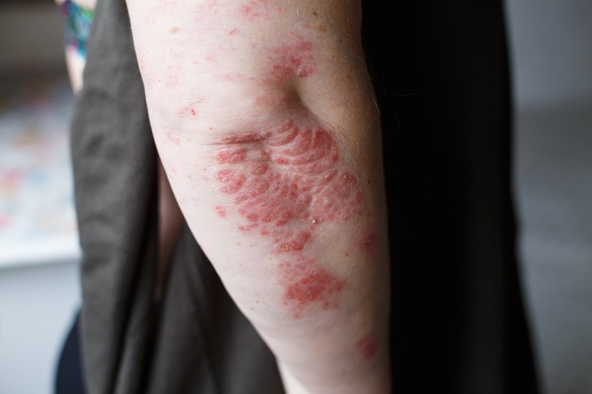 Psoriasis : symptômes et traitements de cette maladie de peau