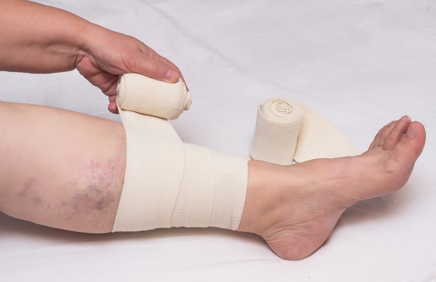 Comment soigner un ulcère de jambe ?