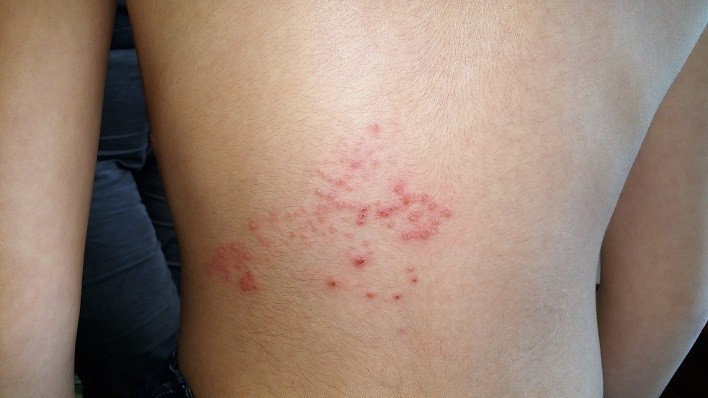 Zona : symptômes, causes et traitements