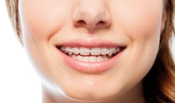 Appareil dentaire orthodontique : pour qui et comment l’entretenir ?