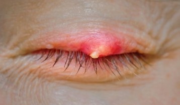 Chalazion et orgelet : comment distinguer et traiter ces deux atteintes des paupières ?