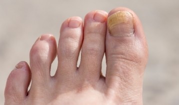 Comment soigner une mycose des ongles ?