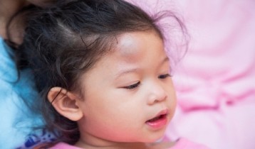 Comment soigner une bosse sur le front ou un œuf de pigeon ?