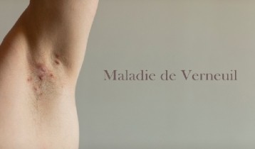 Maladie de Verneuil : causes et traitements