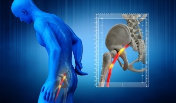 Comment reconnaître et soigner une sciatique ?