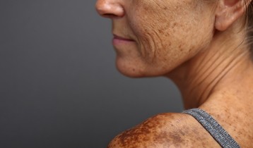 Taches brunes : comment les prévenir et les atténuer