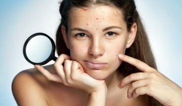 Acné chez la femme : précautions lors d'un traitement à l'isotrétinoïne
