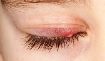La blépharite et l’hygiène des paupières