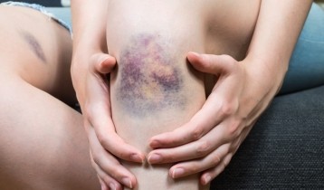 Contusions, bleus et bosses : comment réagir ?
