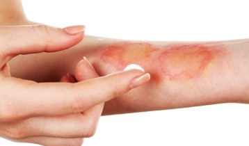 Que faire pour soigner une brûlure ?