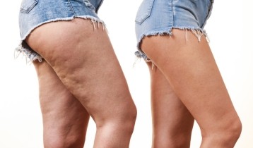 Comment enlever la cellulite ?