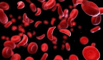 Drépanocytose : comprendre l'anémie falciforme