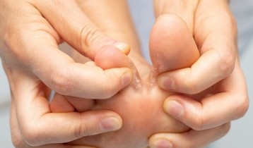 Mycose des pieds : quelles solutions pour traiter le pied d’athlète ?