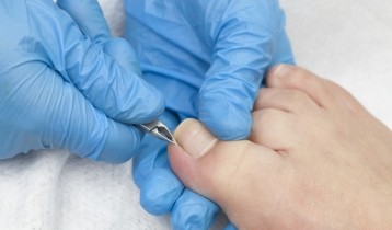 Ongle incarné : que faire ?