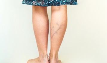 Causes, symptômes et traitements de la phlébite