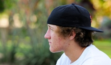 Comment traiter l'acné ?