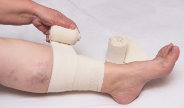 Comment soigner un ulcère de jambe ?