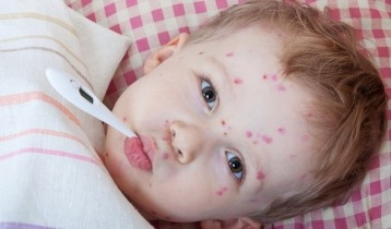 Varicelle : causes, symptômes et traitements