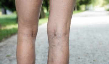 Comment éliminer les varices ?