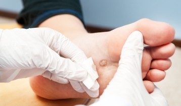 Verrues : types, causes et traitements pour enlever une verrue