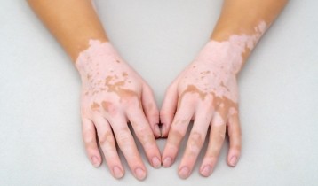 Vitiligo : causes, symptômes et traitements