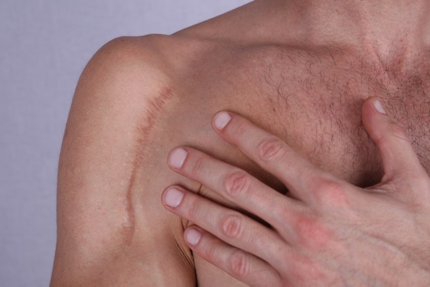 Pourquoi certaines personnes cicatrisent-elles mal ?