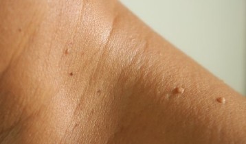 Acrochordon : c'est quoi et comment s'en débarrasser ?