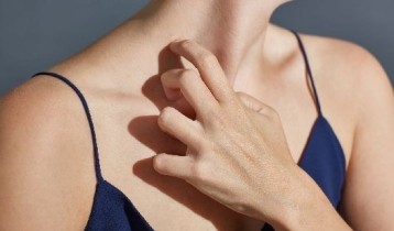 Boutons d’allergie au soleil : quels sont les traitements pour les faire disparaitre ?