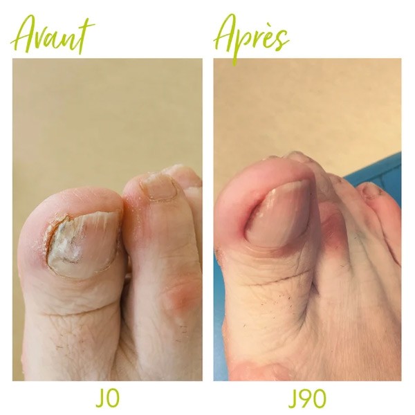 Alvadiem Soin ongles assainissant