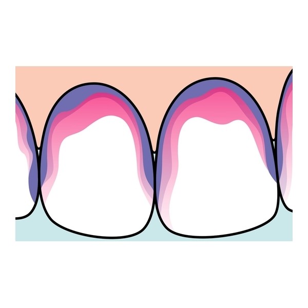 Tepe Plaq Search Révélateur de plaque dentaire comprimés