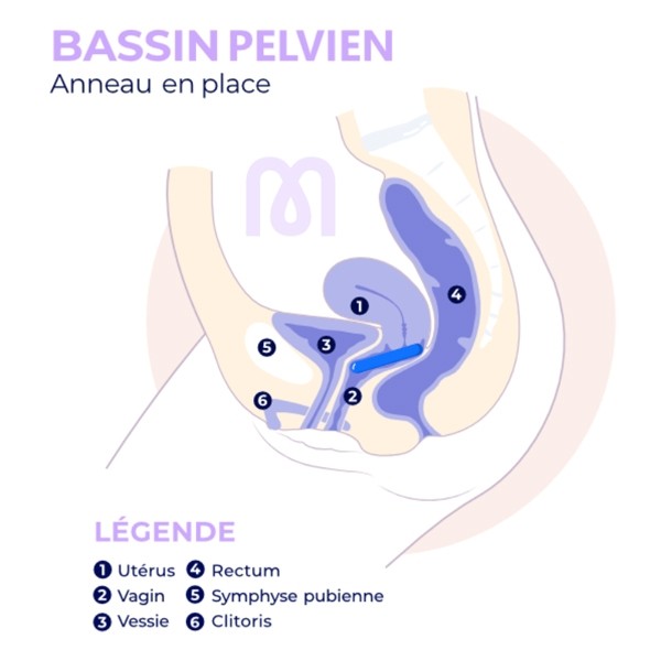 Pessaire Anneau Dr Arabin