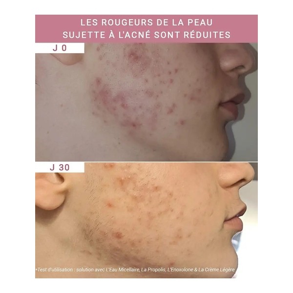 Etat pur Enoxolone 2%